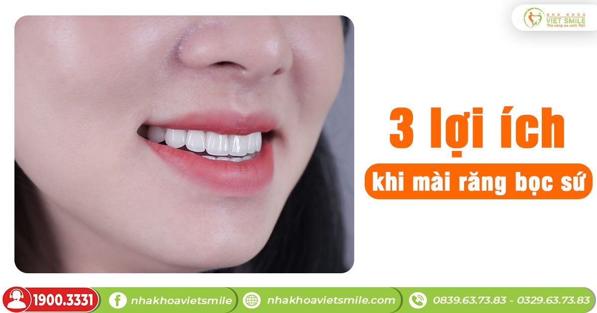 3 lợi ích khi mài răng bọc sứ