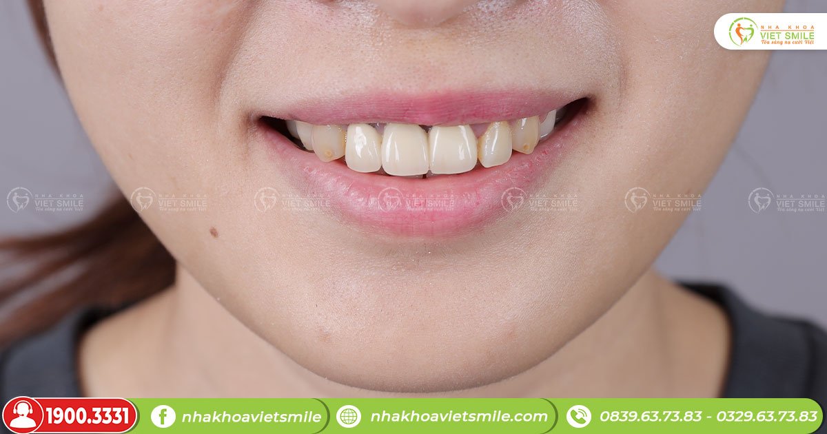 Kẽ răng bị đen là biểu hiện của bệnh gì?