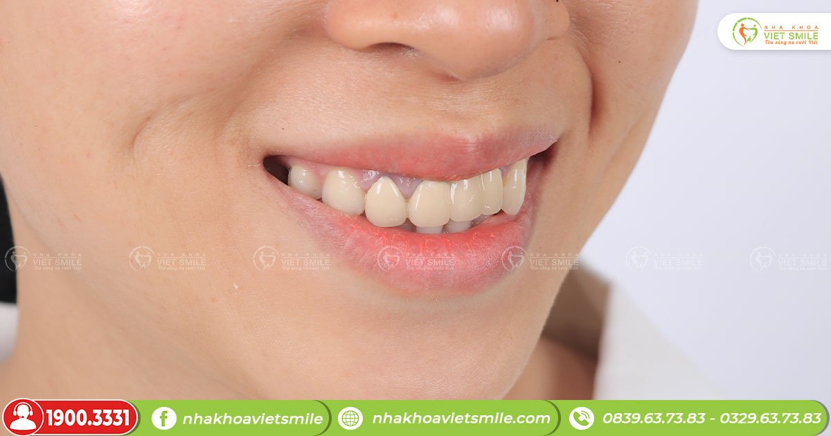 Viêm nướu cũng là nguyên nhân gây ra tình trạng răng bị đen ở kẽ