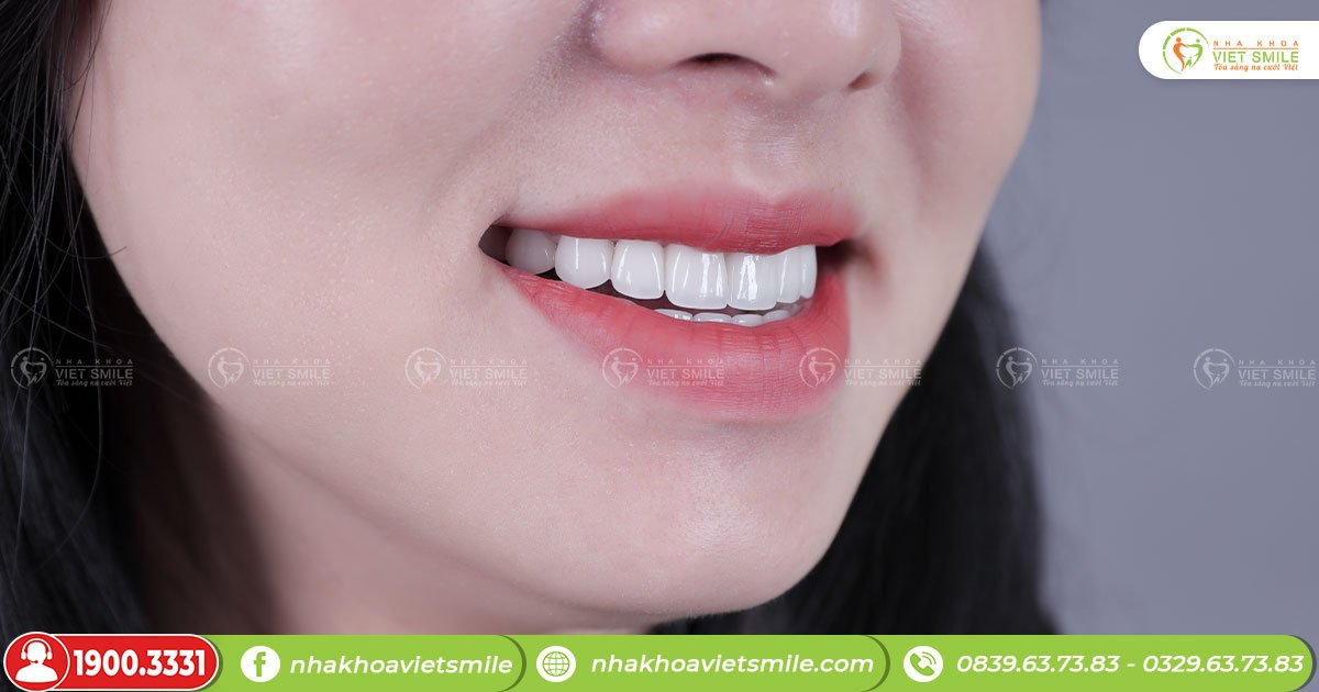 Làm răng sứ giúp bạn thay đổi nụ cười