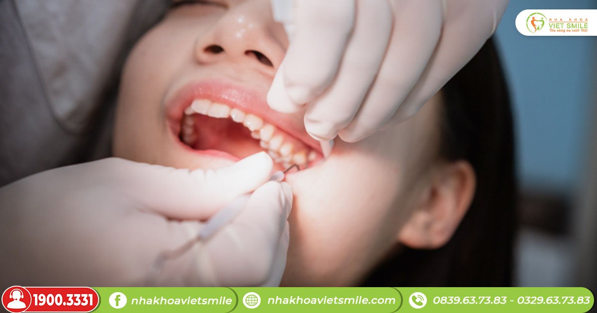 Răng sâu là một tình trạng mà chúng ta rất thường gặp