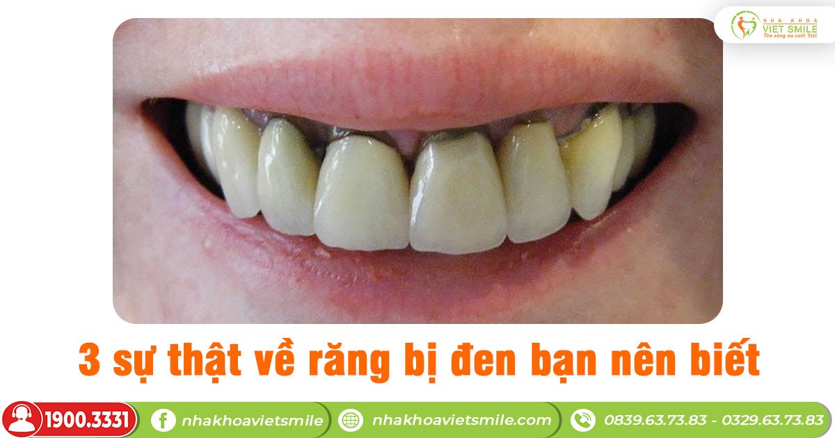 3 sự thật về răng bị đen bạn nên biết