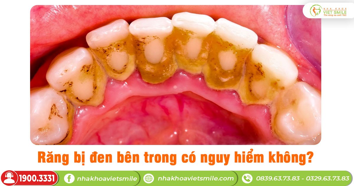 Răng bị đen bên trong có nguy hiểm không?