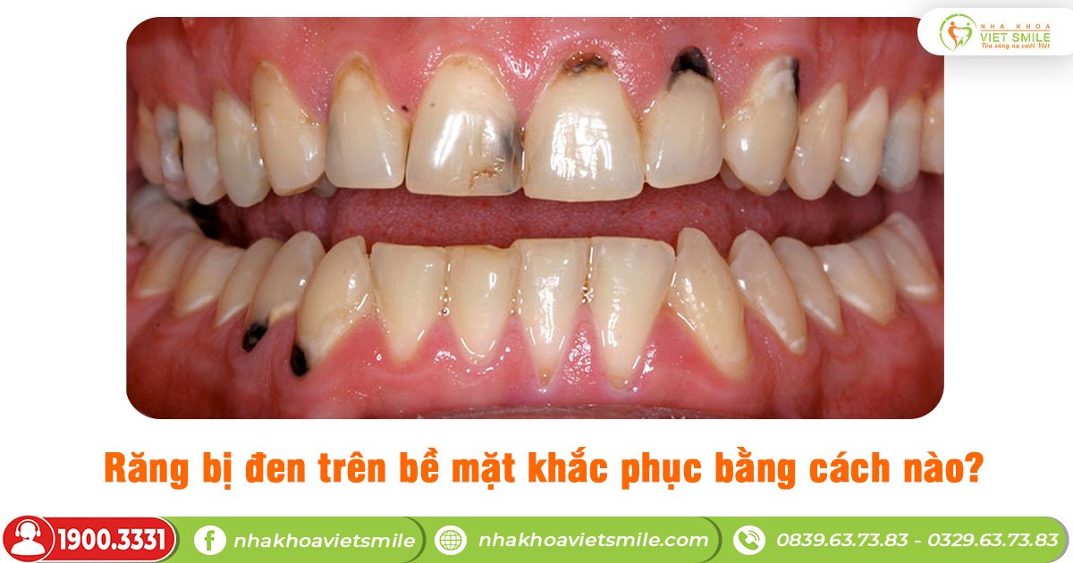 Răng bị đen trên bề mặt khắc phục bằng cách nào?