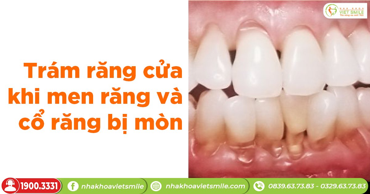 Trám răng cửa khi men răng và cổ răng bị mài mòn