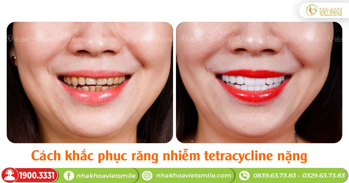Cách khắc phục răng nhiễm tetracycline nặng