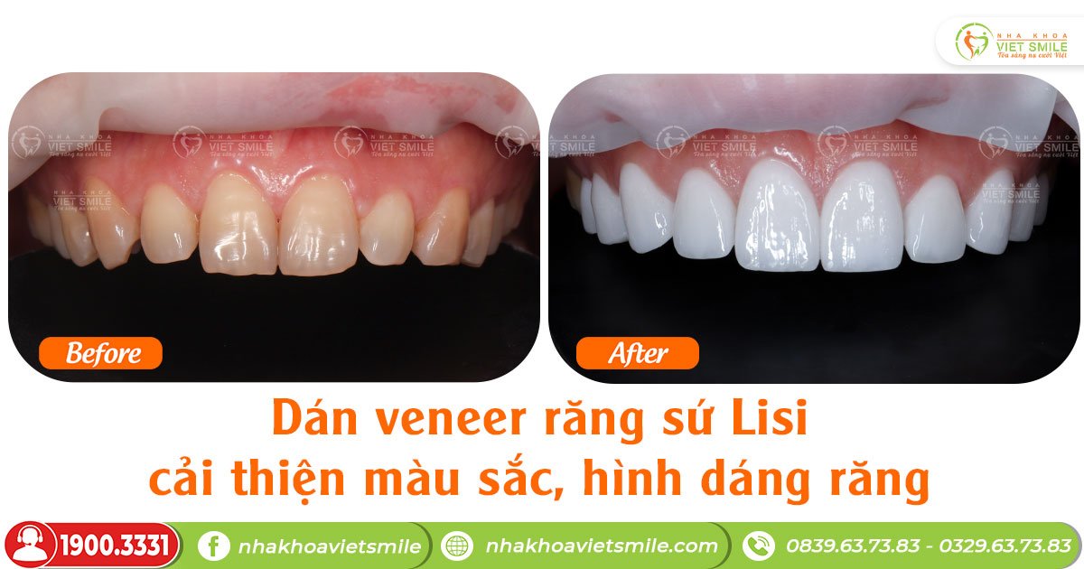 Răng nhiễm tetracycline có tẩy trắng được không? 6 Dán sứ veneer khắc phục răng nhiễm tetracycline nặng