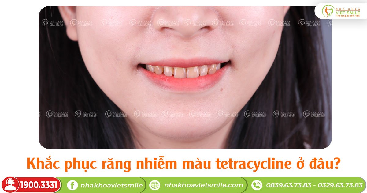 Khắc phục răng nhiễm màu tetracycline ở đâu?