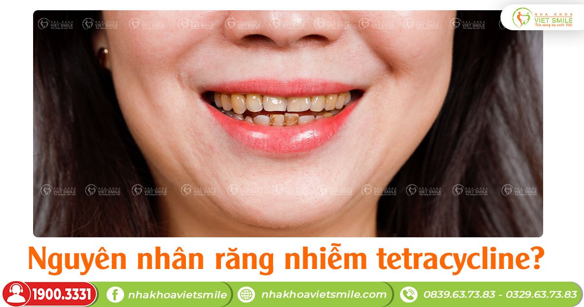Nguyên nhân răng nhiễm tetracycline?