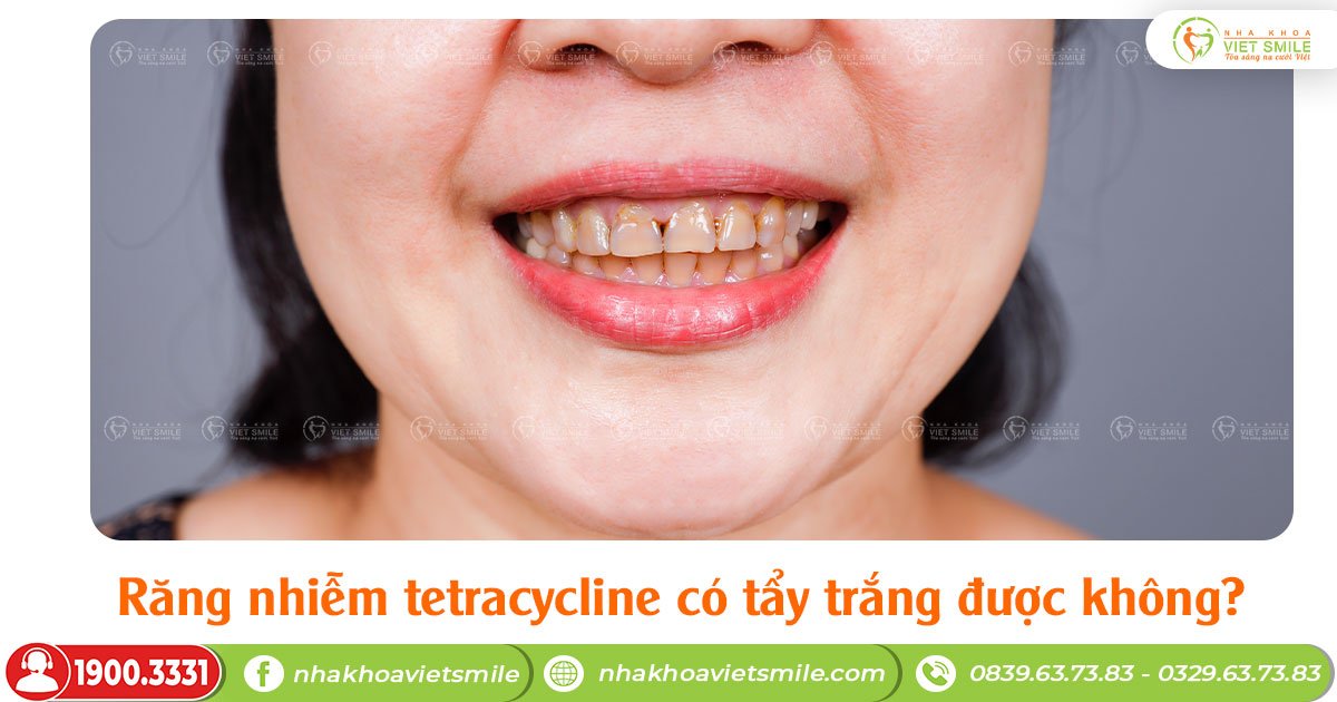 Răng nhiễm tetracycline có tẩy trắng được không?