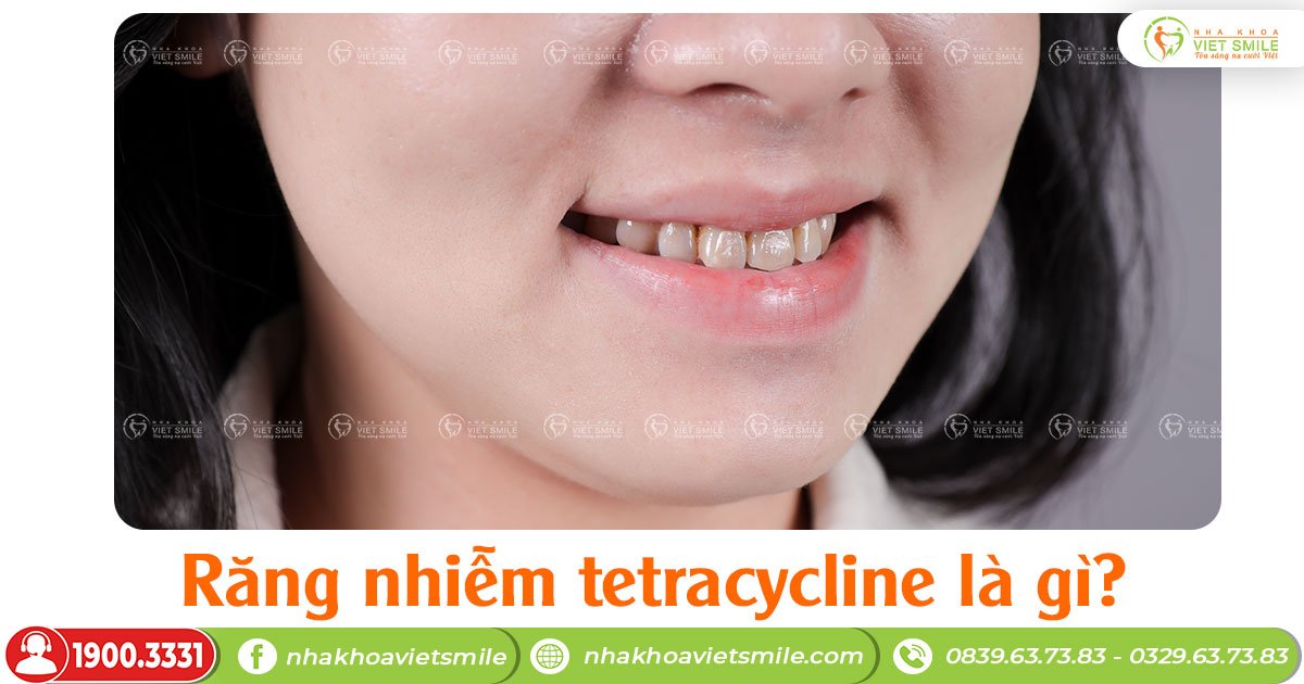 Răng nhiễm tetracycline là gì?