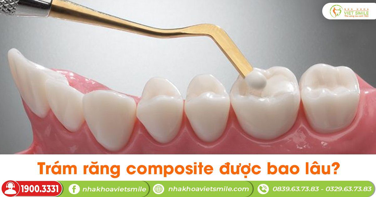 Trám răng composite được bao lâu?