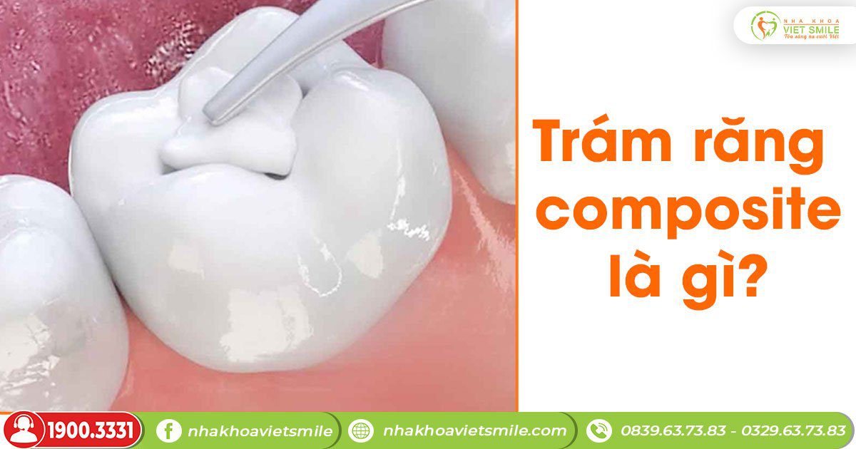 Trám răng composite là gì?
