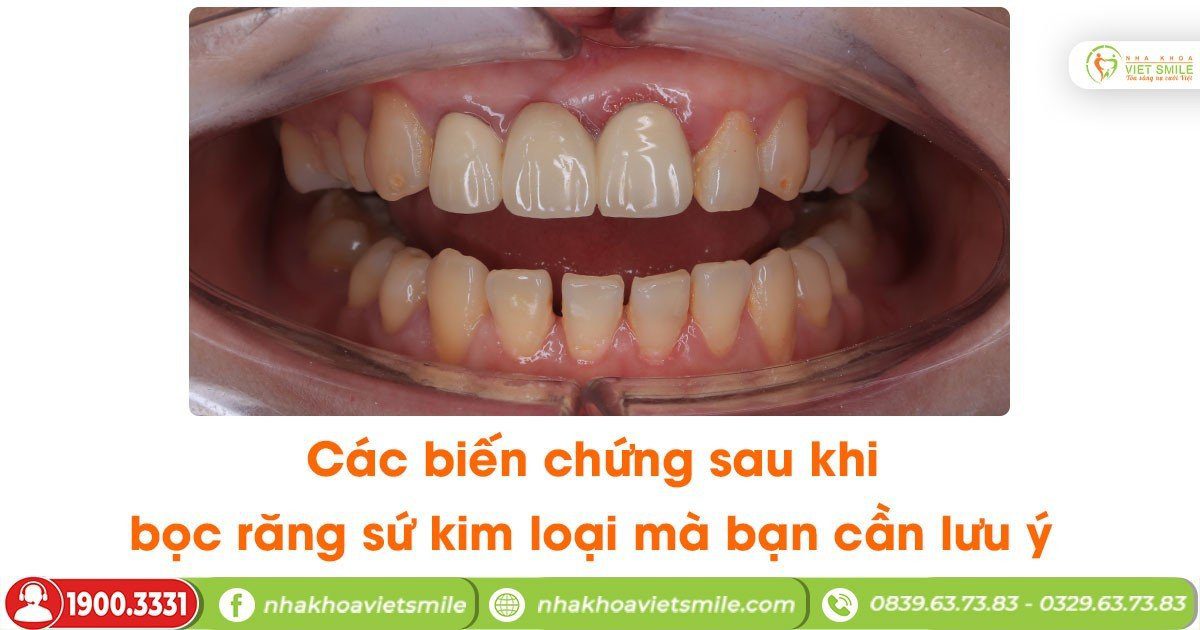 Các biến chứng sau khi bọc răng sứ kim loại mà bạn cần lưu ý