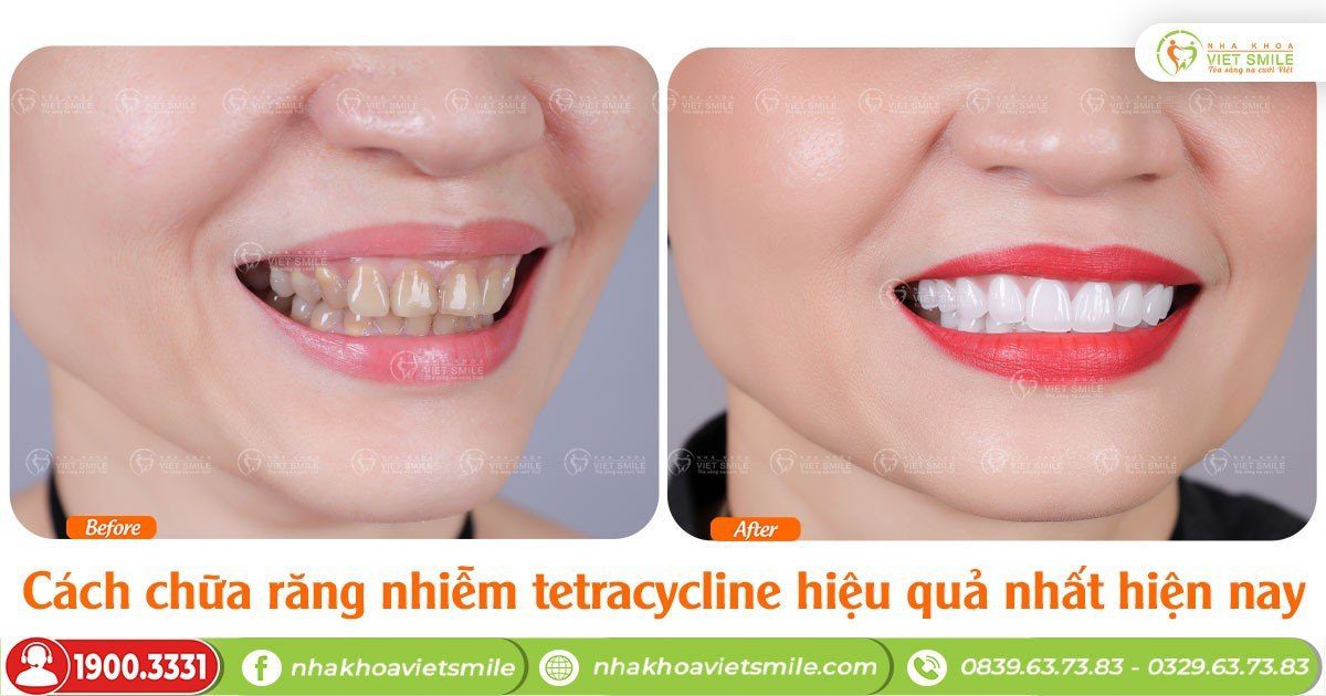 Cách chữa răng nhiễm tetracycline hiệu quả nhất hiện nay