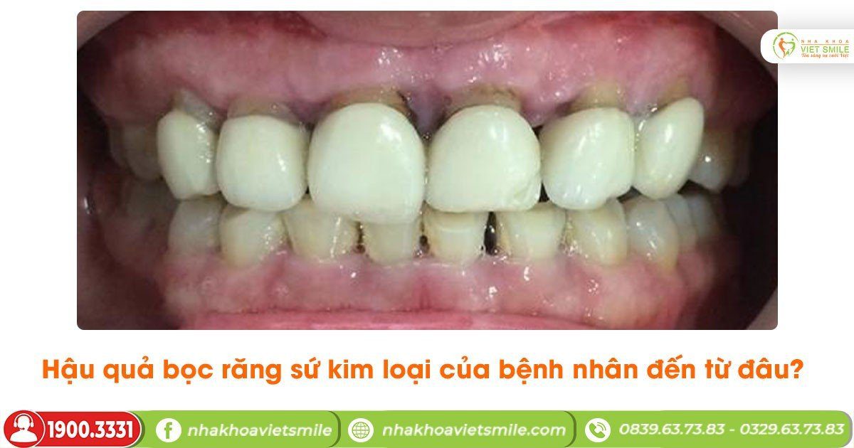 Hậu quả bọc răng sứ kim loại của bệnh nhân đến từ đâu?