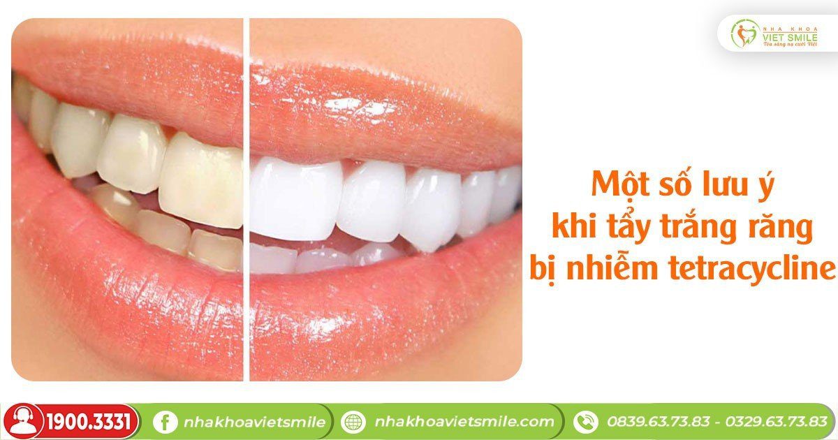 Một số lưu ý khi tẩy trắng răng bị nhiễm tetracycline
