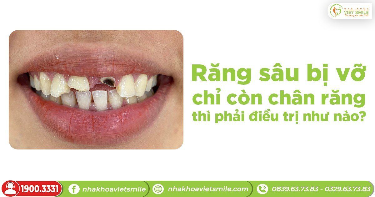 Răng sâu bị vỡ chỉ còn chân răng thì phải điều trị như thế nào?