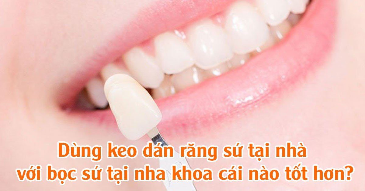 Dùng keo dán răng sứ với bọc sứ tại nha khoa cái nào tốt hơn?  