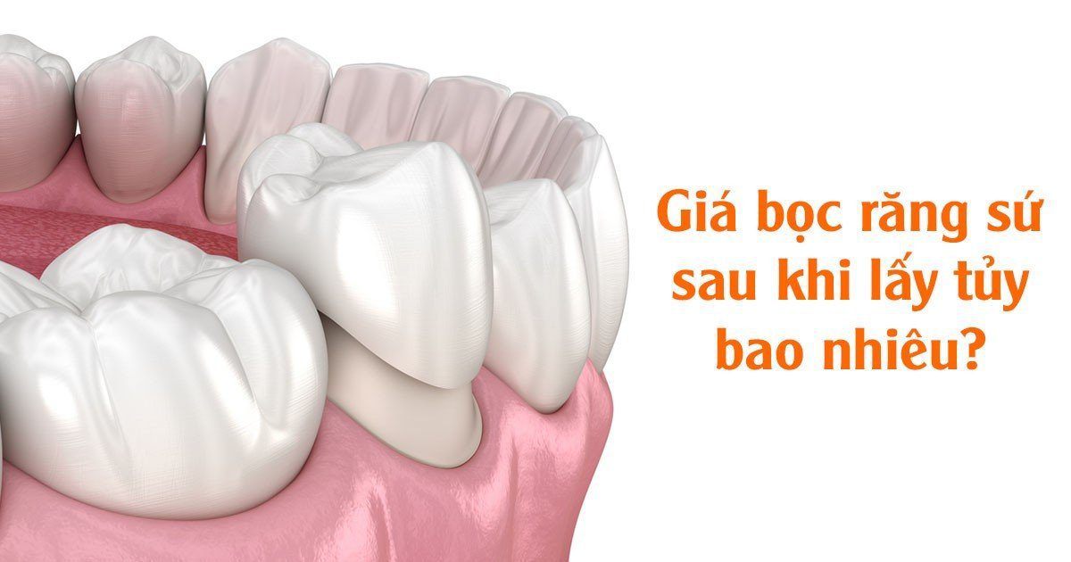 Giá bọc răng sứ sau khi lấy tủy bao nhiêu?