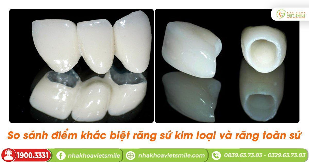 So sánh điểm khác biệt răng sứ kim loại và răng toàn sứ