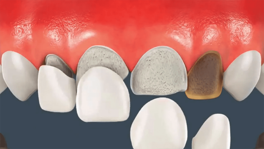 Dán sứ sai kỹ thuật gây ra các bệnh răng miệng