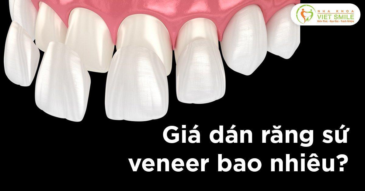 Giá dán răng sứ veneer bao nhiêu?