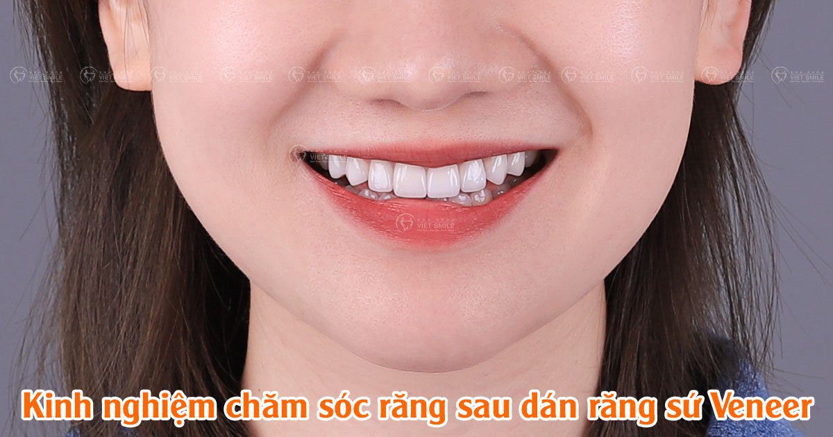 Kinh nghiệm chăm sóc răng sau dán răng sứ veneer