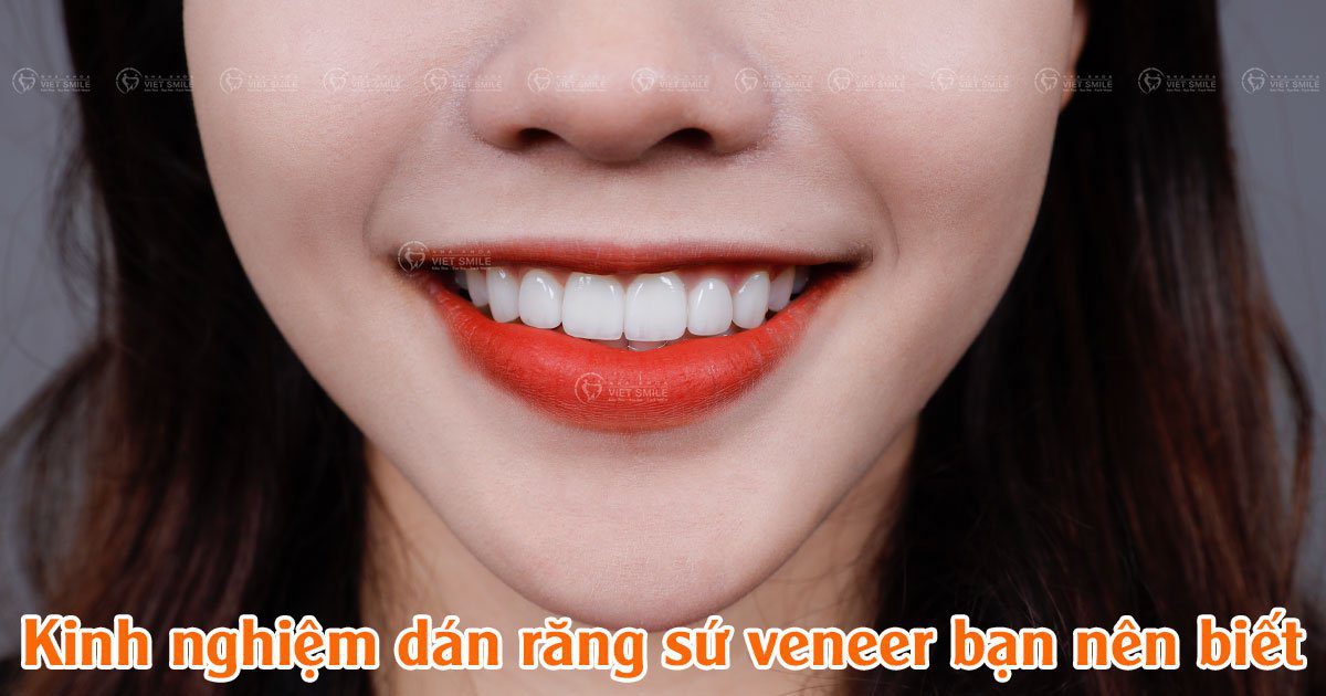 Kinh nghiệm dán răng sứ veneer bạn nên biết