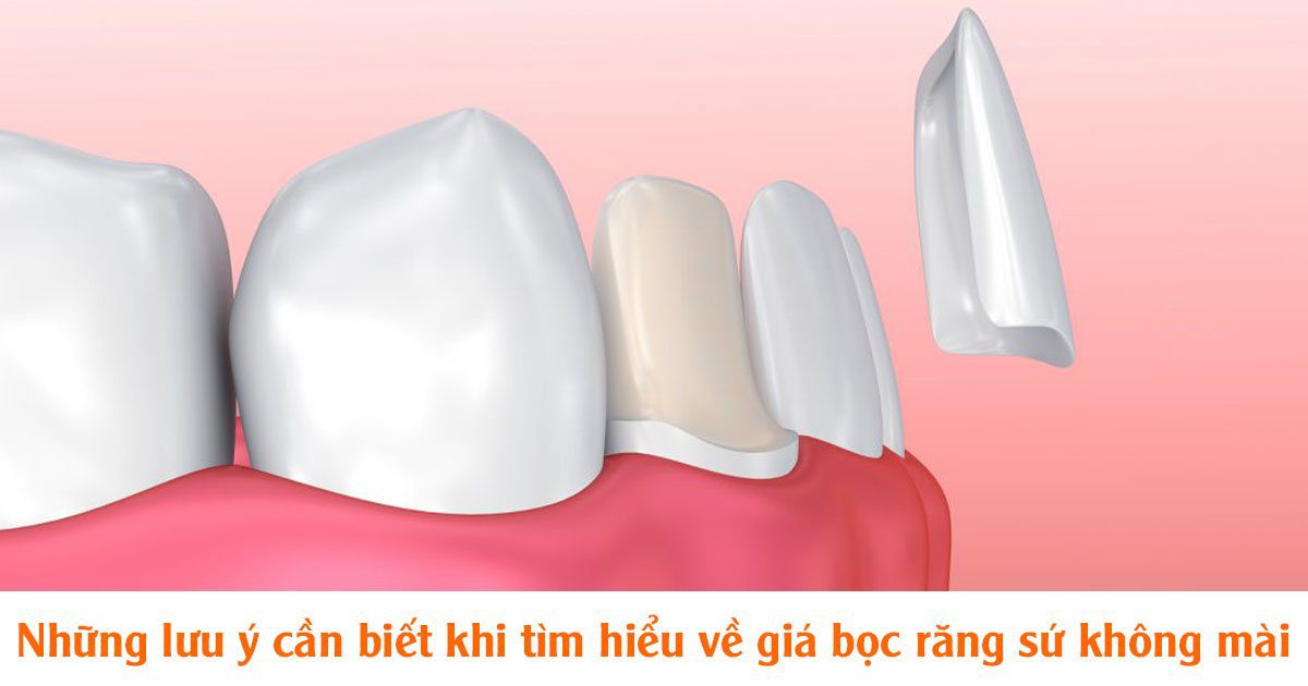 Những lưu ý cần biết khi tìm hiểu về giá bọc răng sứ không mài