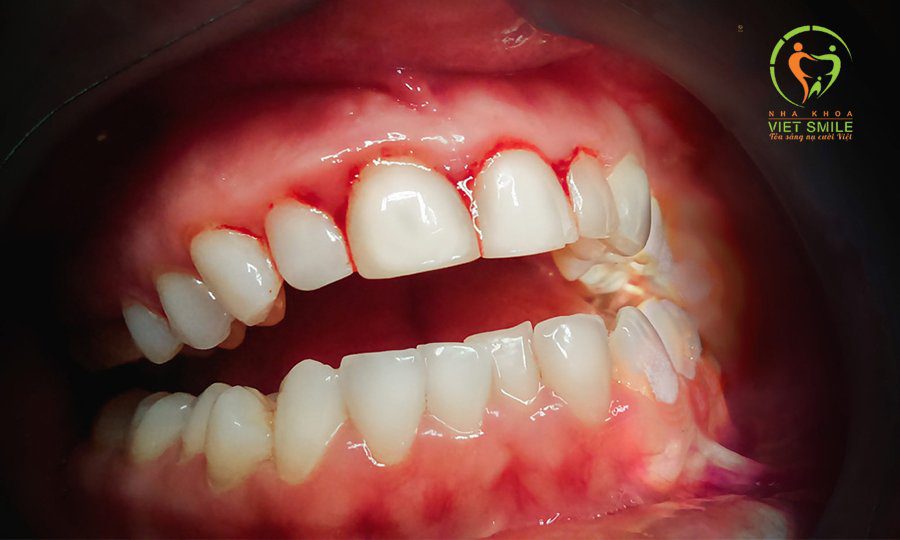 Chân răng sứ bị viêm nhiễm