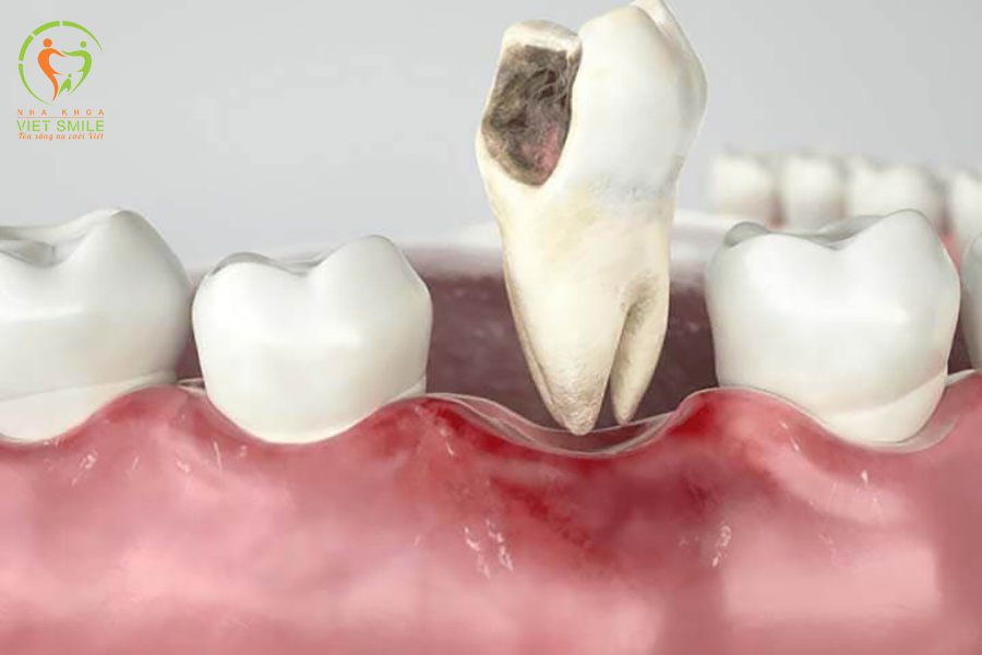 Răng bị chấn thương nặng