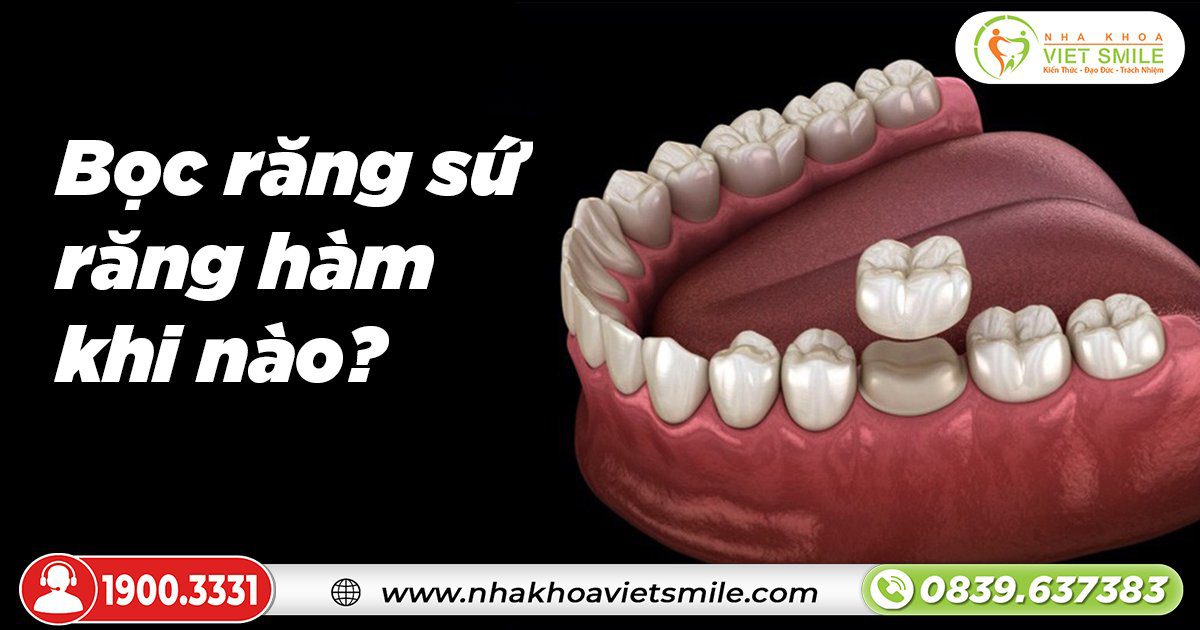 Bọc răng sứ răng hàm khi nào?