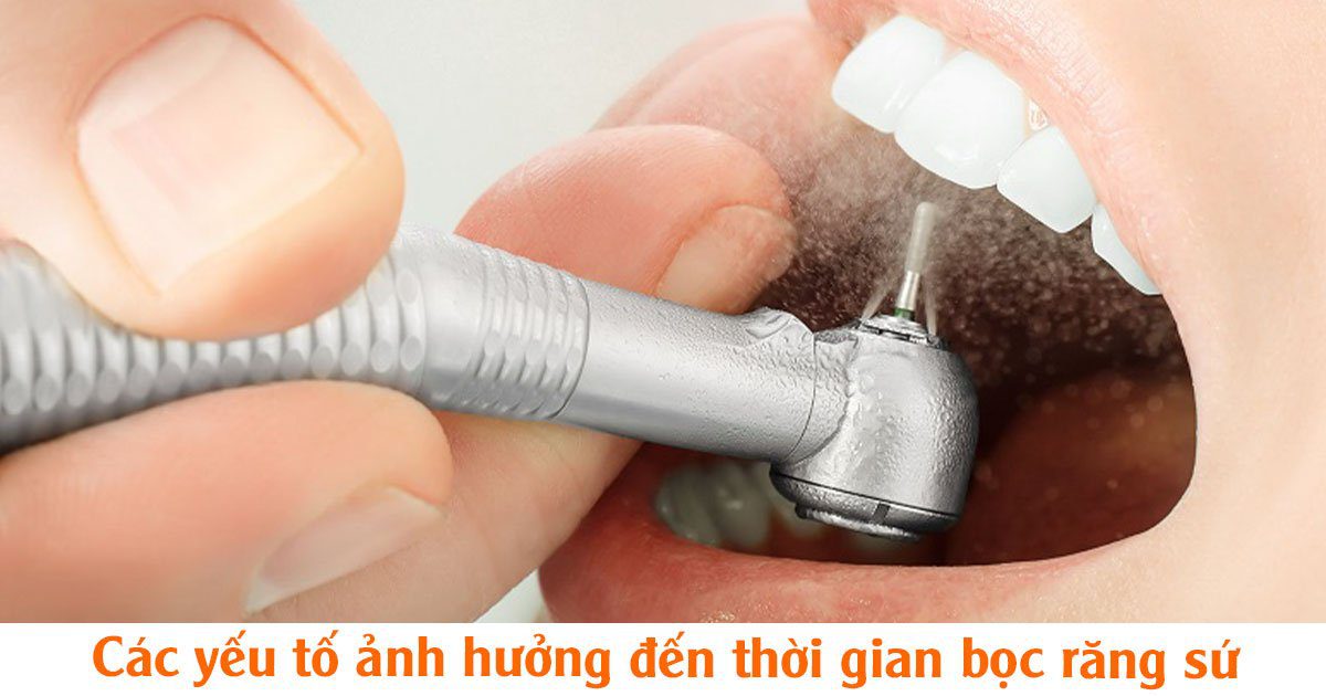 Các yếu tố ảnh hưởng đến thời gian bọc răng sứ