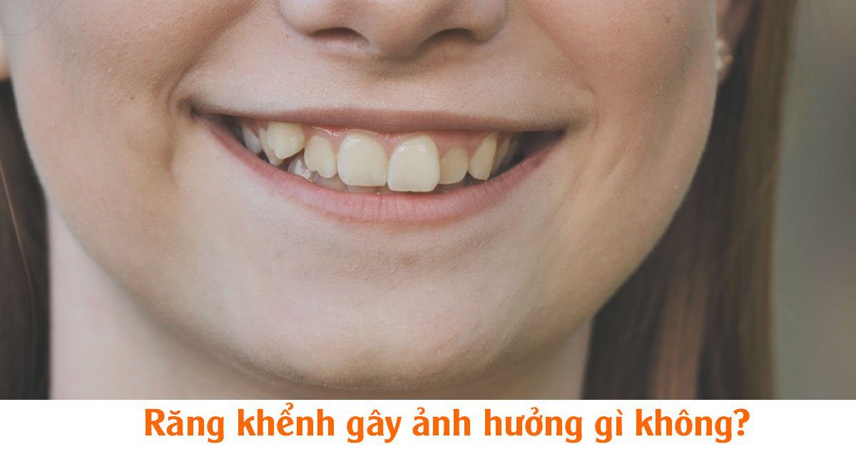 Răng khểnh gây ảnh hưởng gì không?