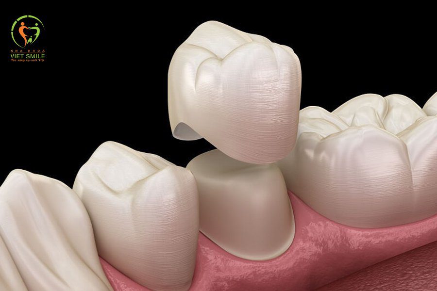 Những trường hợp bọc răng sứ mà không cần phải lấy tủy