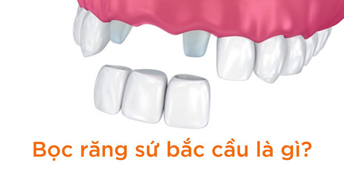 Bọc răng sứ bắc cầu là gì?