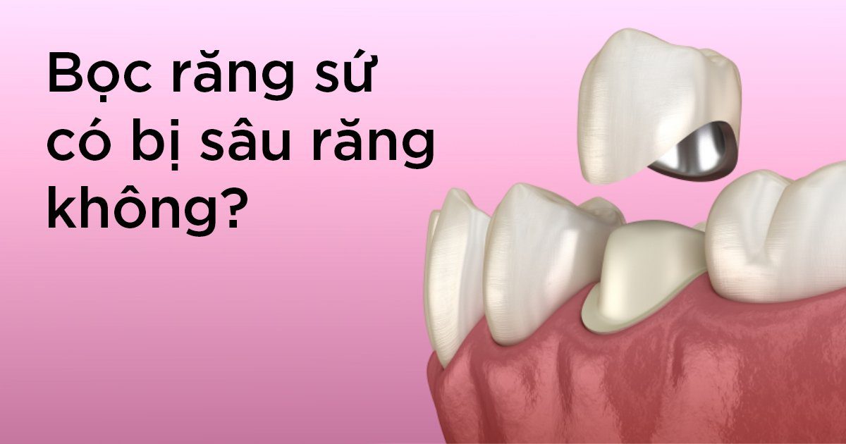 Bọc răng sứ có bị sâu răng không?