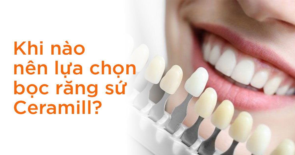 Khi nào nên lựa chọn bọc răng sứ ceramill?