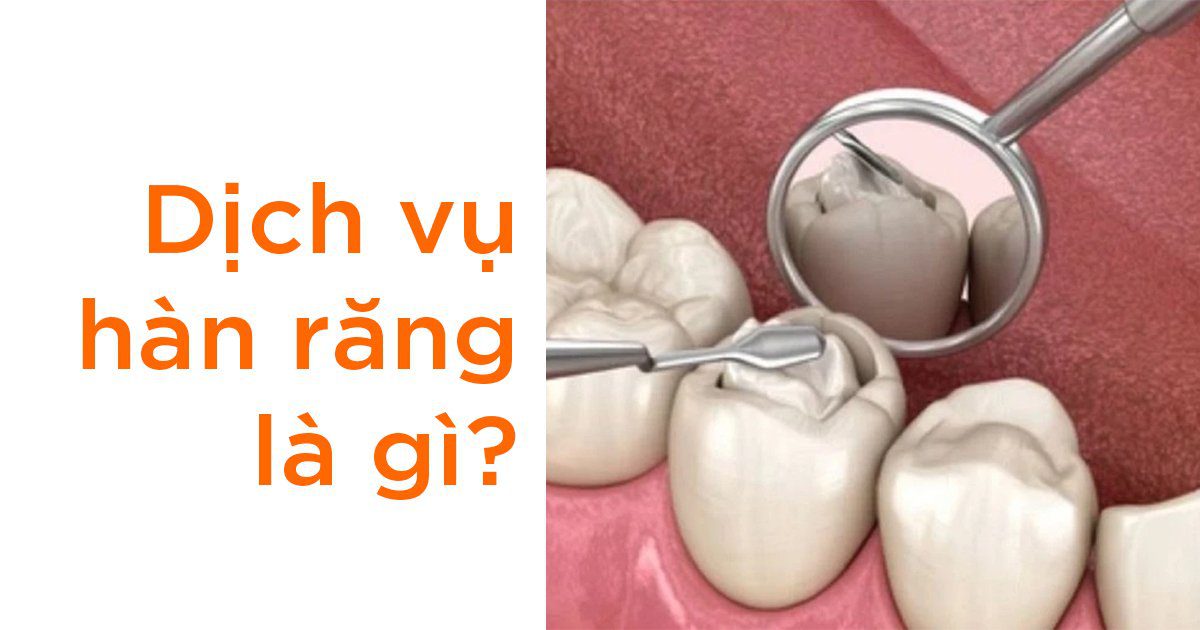 Dịch vụ hàn răng là gì?