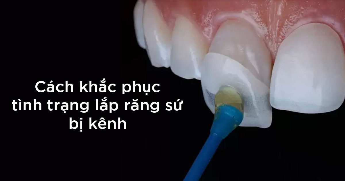 Cách khắc phục tình trạng lắp răng sứ bị kênh