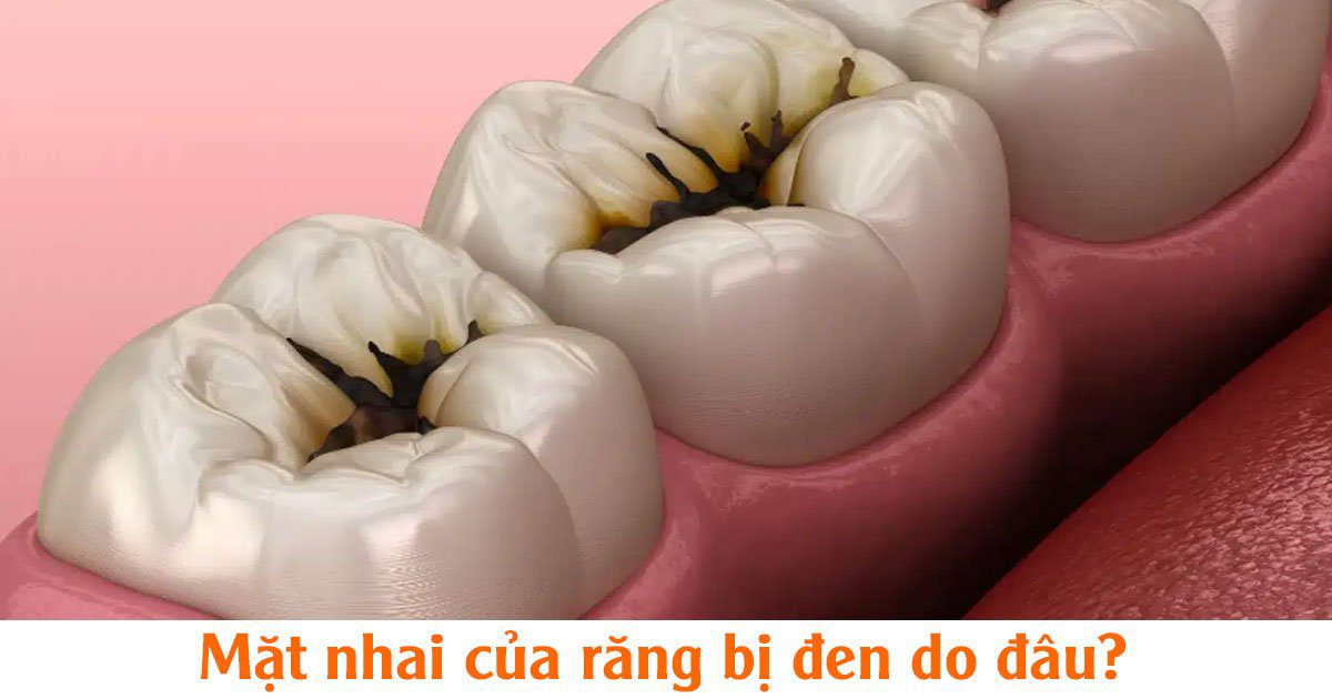 Mặt nhai của răng bị đen do đâu?