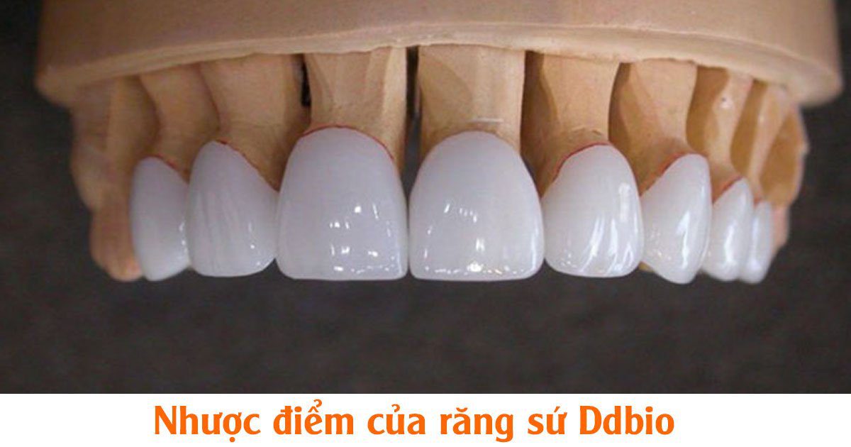 Nhược điểm của răng sứ ddbio