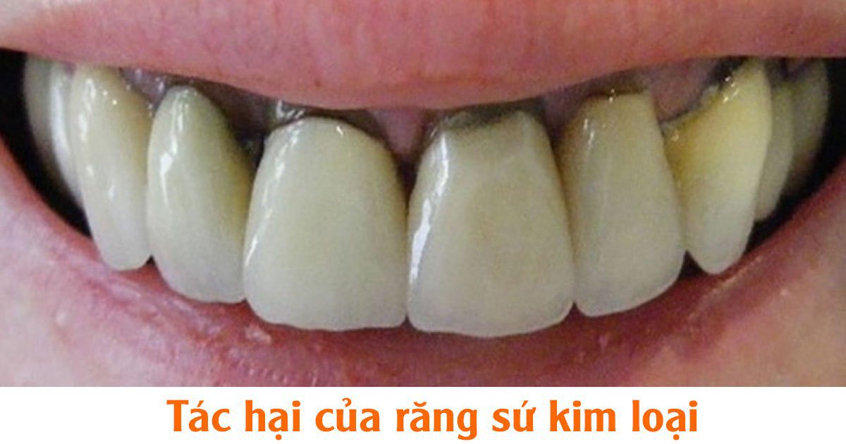 Tác hại của răng sứ kim loại