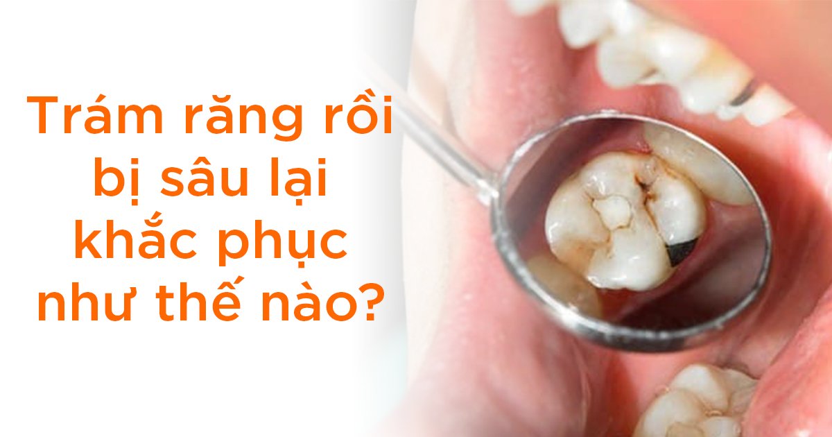 Trám răng rồi bị sâu lại khắc phục như thế nào?