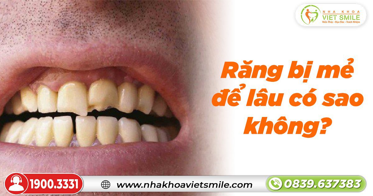 Răng bị mẻ để lâu có sao không?