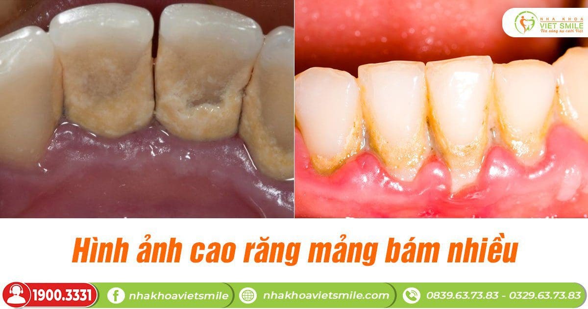 Cao răng đen là gì? Có nên loại bỏ sớm?