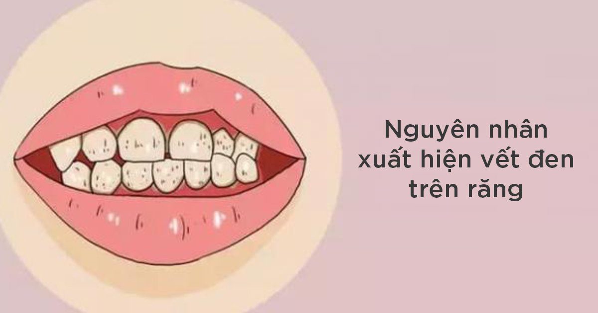 Nguyên nhân xuất hiện vết đen trên răng là gì?