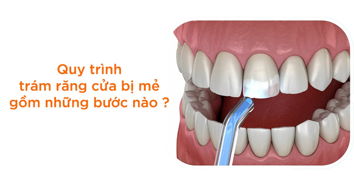 Quy trình trám răng cửa bị mẻ gồm những bước nào?