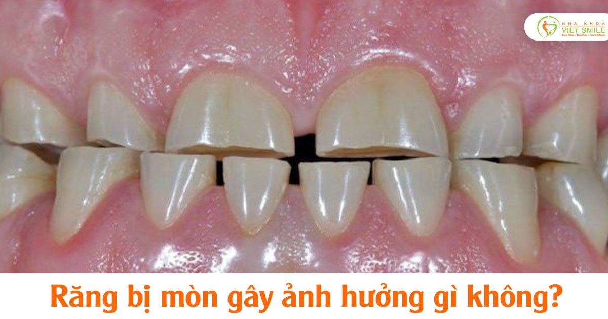 Răng bị mòn gây ảnh hưởng gì không?